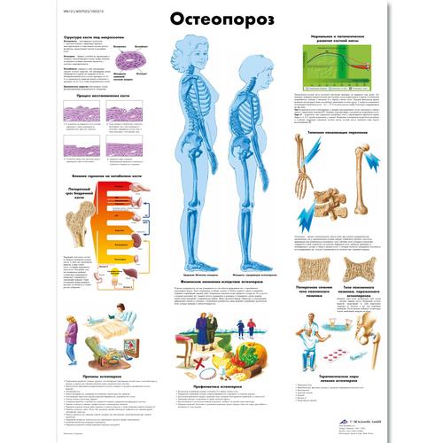 Медицинский плакат "Остеопороз", 1002215 [VR6121L], Sistema Esquelético