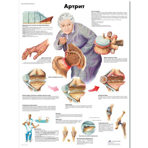 Медицинский плакат "Артрит", 1002217 [VR6123L], Плакаты по опорно-двигательному аппарату человека