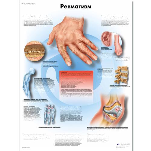 Медицинский плакат "Ревматизм", 1002219 [VR6124L], Плакаты по опорно-двигательному аппарату человека