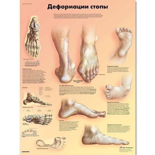 Медицинский плакат "Деформация стопы", 1002234 [VR6185L], système Squelettique