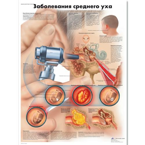 Медицинский плакат "Заболевания среднего уха", 1002247 [VR6252L], Плакаты по Уху, Горлу, Носу (ЛОР)