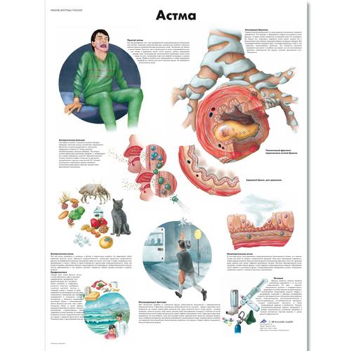 Медицинский плакат "Астма", 1002260 [VR6328L], Atmungssystem