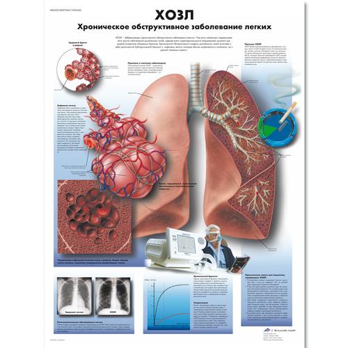 Медицинский плакат "ХОЗЛ - хроническое обструктивное заболевание легких", 1002262 [VR6329L], Плакаты по дыхательной системе человека