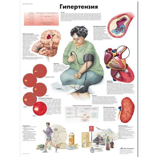 Медицинский плакат "Гипертензия", 1002274 [VR6361L], Herz-Kreislauf-System
