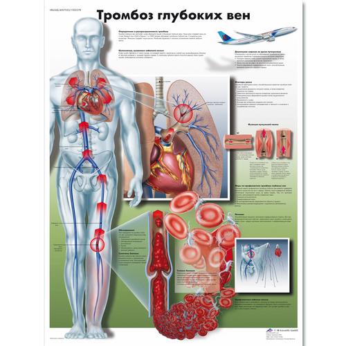 Медицинский плакат "Тромбоз глубоких вен", 1002278 [VR6368L], Herz-Kreislauf-System