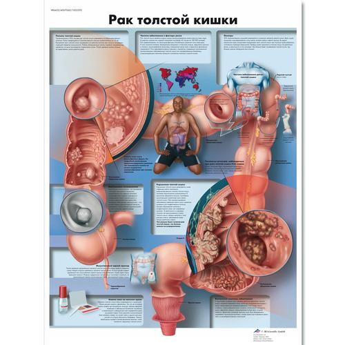 Медицинский плакат "Рак толстой кишки", 1002292 [VR6432L], Cancers
