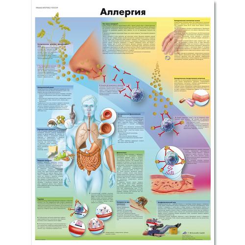 Медицинский плакат "Аллергия", 1002339 [VR6660L], Плакаты по иммунной системе