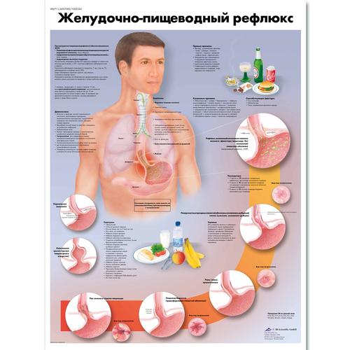Медицинский плакат "Желудочно-пищевой рефлюкс", 1002343 [VR6711L], Système digestif
