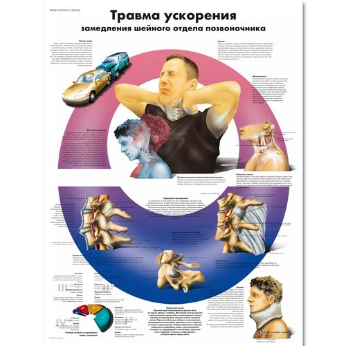 Медицинский плакат "Травма ускорения шейного отдела позвоночника", 1002355 [VR6761L], Skelettsystem