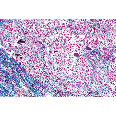 Human Pathology - German Slides, 1004094 [W13311], German