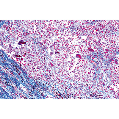 Pathologie humaine série de base - Allemand, 1004094 [W13311], Préparations microscopiques LIEDER