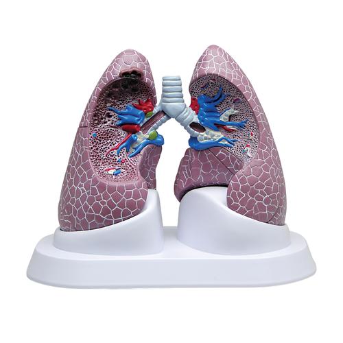 双侧肺模型, 1018749 [W33371], 肺模型