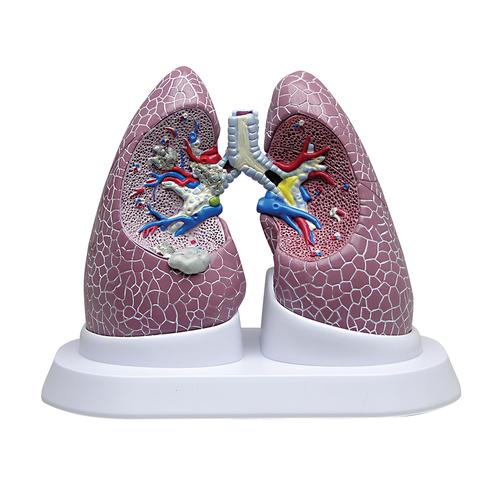 Conjunto de Pulmão com Patologias, 1018749 [W33371], Modelo de pulmão