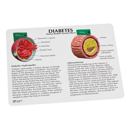 4-Piece Diabetes Model, 1019574 [W33387], Diabetic Teaching Tools