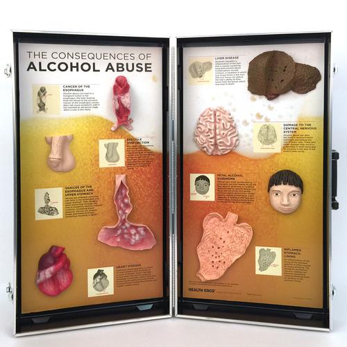 酗酒的后果–3D展示板, 1005582 [W43053], 药物滥用和酒精滥用教育训练模型