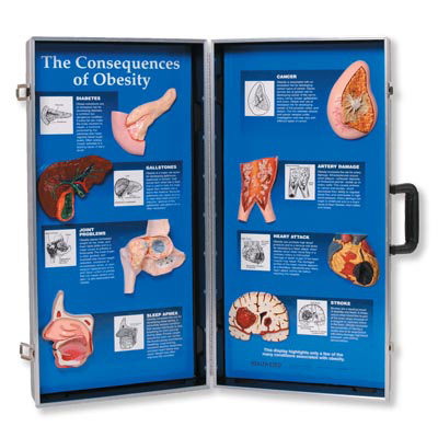 The Consequences of Obesity 3D Display, 3004616 [W43057], Nutrition Education