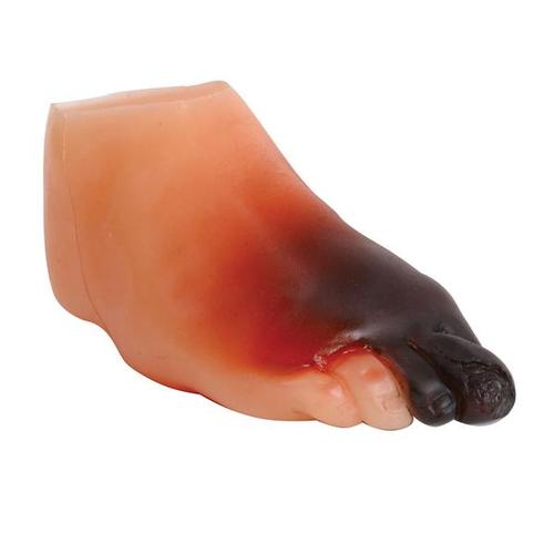 Mod&egrave;le de pied de diab&eacute;tique s&eacute;v&egrave;re, 1017937 [W43107A], Outils d&rsquo;&eacute;ducation au diab&egrave;te