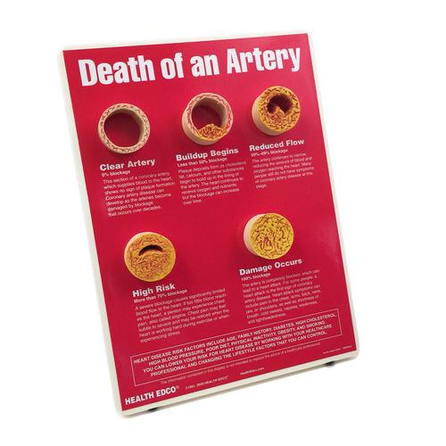 Death of An Artery Easel Display, 1018290 [W43121], 심장 건강 및 운동 교육