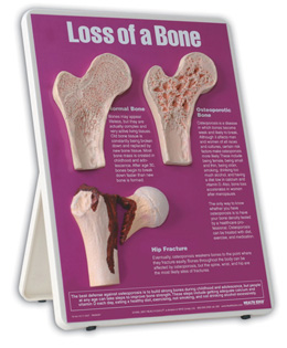 Loss of Bone Easel Display, 3004674 [W43124], Arthritis and Osteoporosis Education