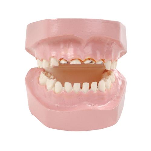 Modelo de deterioro dental por "caries del biberón", 1018302 [W43157], Educación para padres