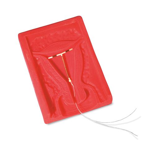 Mise en place d’un stérilet (stérilet non fourni)., 1005766 [W44615], Education au préservatif