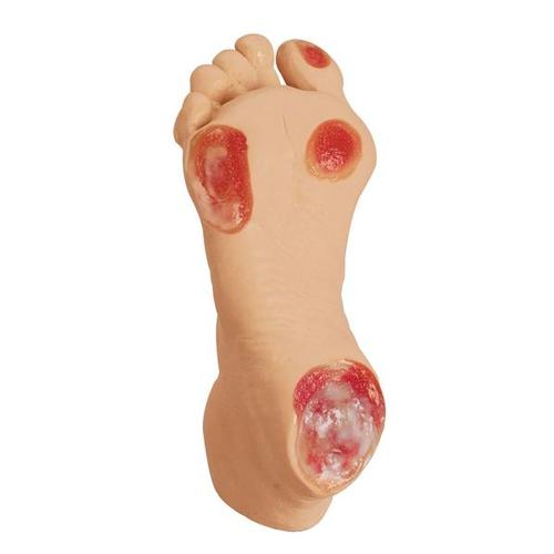 노인성 욕창 발 Elderly Pressure Ulcer Foot, 1013058 [W44757], 욕창간호