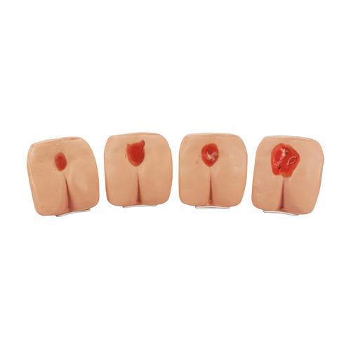 Pressure Ulcer/Bedsore Models light, 1017979 [W44788W], Decubitus Care