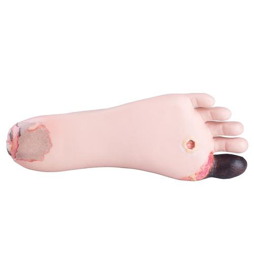Ulcerated Foot, 1019238 [W45016], Decubitus Care