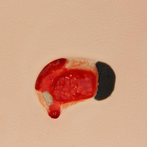 "Pat" Pressure Ulcer Staging Model&trade;, 3001171 [W46517], Decubitus Care