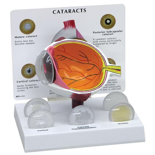 Глаз с катарактой, 1019536 [W47852], Модели глаза человека