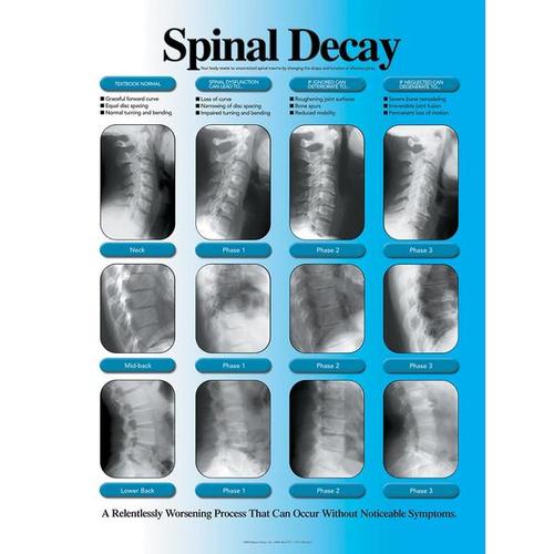 Spinal Decay Chart - Right Facing, Laminated, W57500, Sistema Esquelético