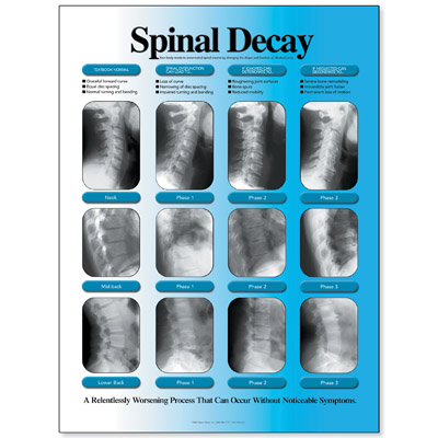 Spinal Decay Chart - Left Facing, Laminated, W57501, Skeletal System