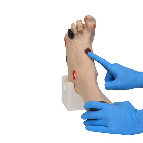 Wilma 상처 발™  Wilma Wound Foot™, 1017978 [w46516], 욕창간호
