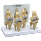 Комплект моделей коленного сустава по 4-м стадиям остеоартроза, 1019502, Модели суставов, кисти и стопы человека