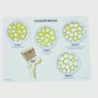 Knochenkrebs&shy;Scheibenset - 4 Stadien der Osteoporose, 1019509, Wirbelmodelle (Small)