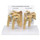 Modello di spalla con osteoartrite (4 stadi), 1019514, Modelli delle Articolazioni