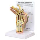 Modello di mano con artrite reumatoide, 1019521, Modelli di scheletro della mano e del braccio