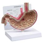 Modelo de estómago con úlceras, 1019523, Modelos del Sistema Digestivo