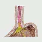4-pc Gerd - (Gastro Esophageal Reflux Disease), 1019525, Digestive System Models (Small)