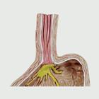 4-pc Gerd - (Gastro Esophageal Reflux Disease), 1019525, Digestive System Models (Small)