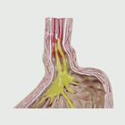 4-pc Gerd - (Gastro Esophageal Reflux Disease), 1019525, Digestive System Models (Small)