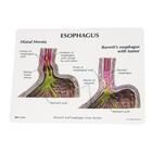 4-pc Gerd - (Gastro Esophageal Reflux Disease), 1019525, Digestive System Models (Small)