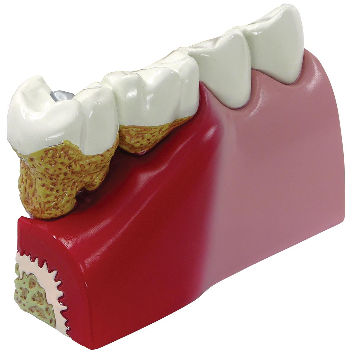 牙周病模型- 1019539 - 2860 - 牙齿模型- 3B Scientific