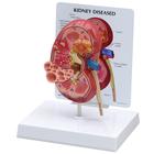 Diseased Kidney Model, 1019550, 消化系统
