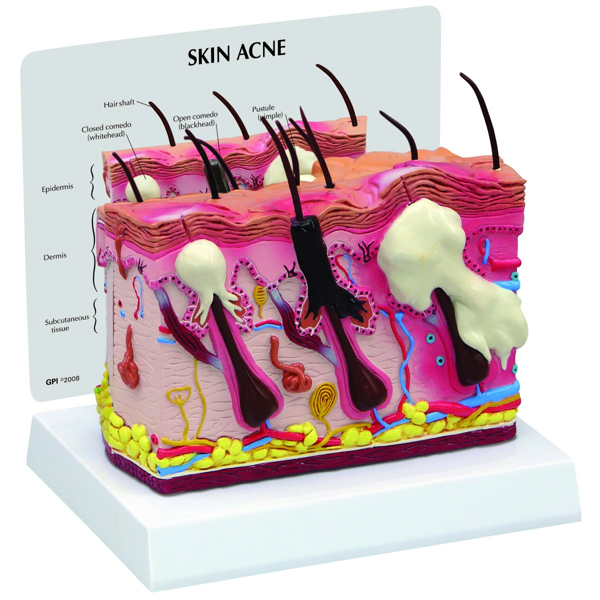  Skin  Acne Model  2 Sided 1019568 3751 Anatomy Teaching Models  Skin  Cancer Model  Hair 