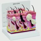 Skin Acne Model, 2 Sided, 1019568, Skin Models (Small)