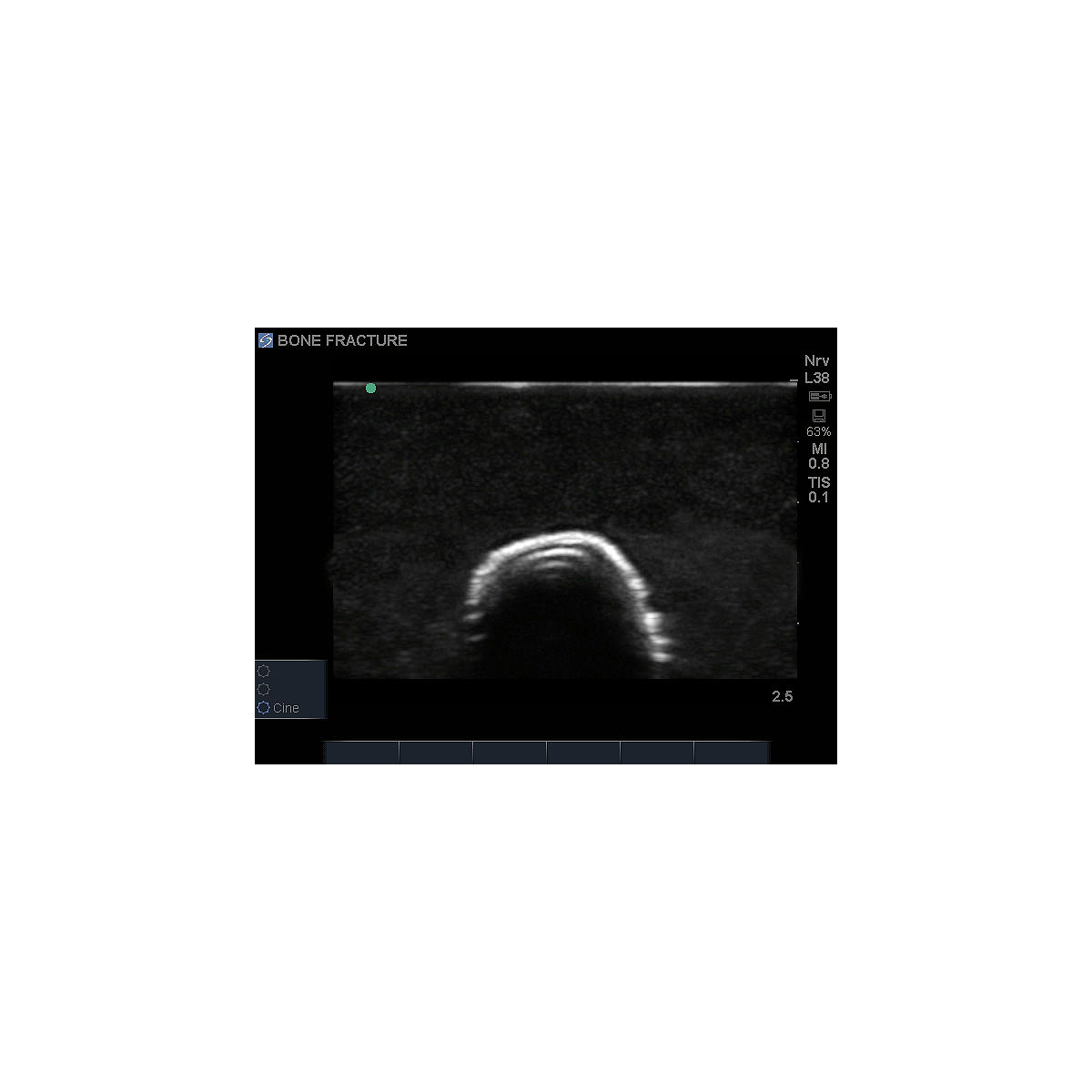 Blue Phantom Bone Fracture Ultrasound Training Block Model - Crepitus ...