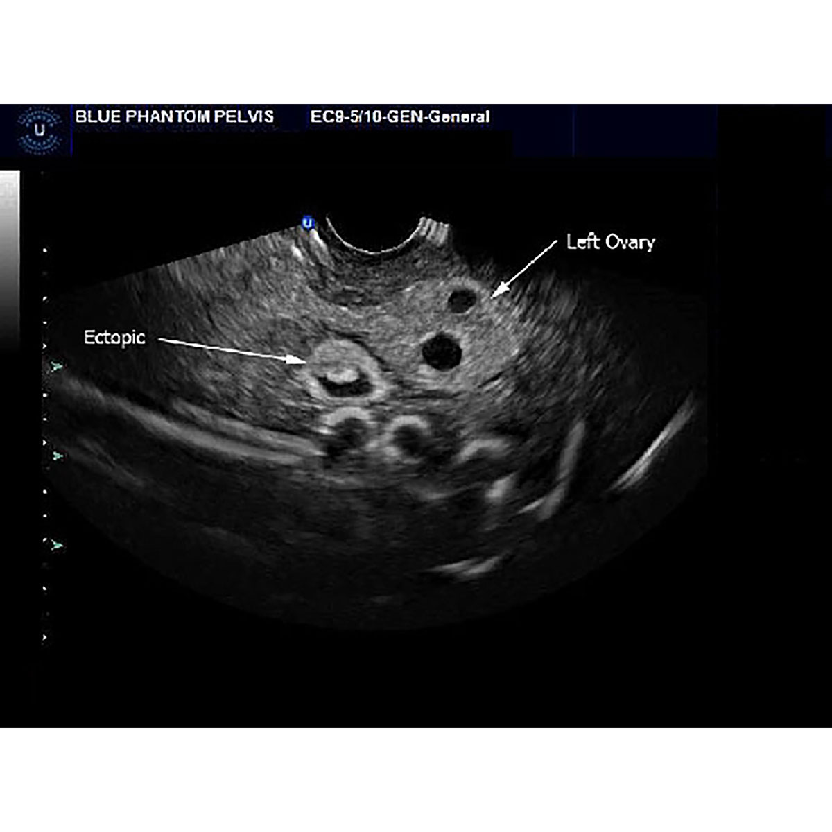 Transvaginal Ultrasound Images Of An Ectopic Cervical Pregnancy Empty ...