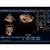 Blue Phantom General Pathology Transvaginal Ultrasound Training Model, 3012484, Ultrasound Skill Trainers (Small)