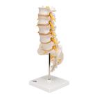 Human Lumbar Spinal Column Model with Dorso-Lateral Prolapsed Intervertebral Disc, 1000150 [A76/5], Vertebra Models (Small)